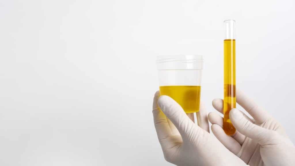 urine jaune fluo
